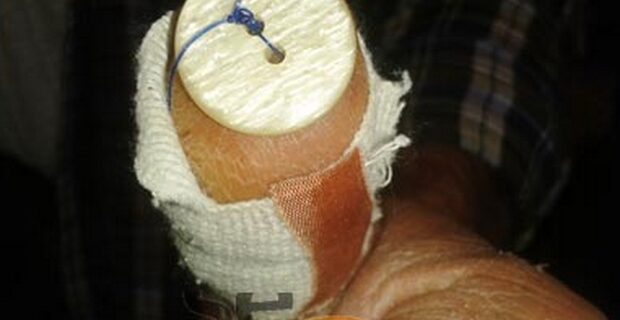 Καταγγελία: Του έραψαν κουμπί για να κλείσουν το τραύμα