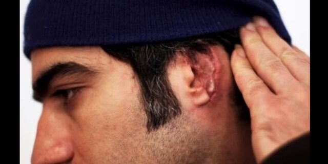 Νέο ρατσιστικό παραλήρημα: Ιρανός καταγγέλλει ότι μαυροφορεμένοι του έκοψαν το αυτί με τα δόντια
