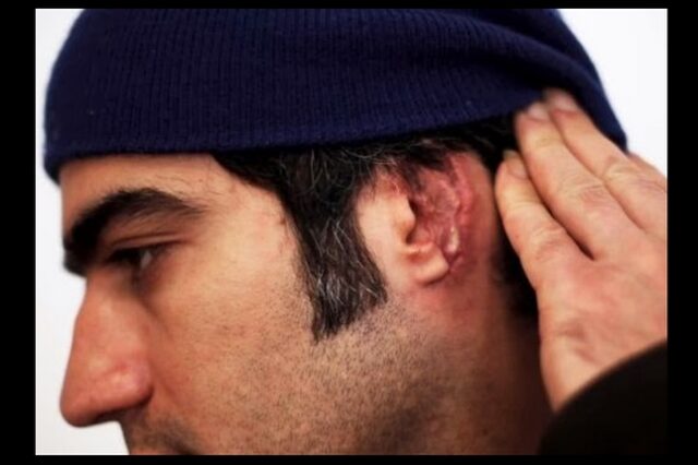 Νέο ρατσιστικό παραλήρημα: Ιρανός καταγγέλλει ότι μαυροφορεμένοι του έκοψαν το αυτί με τα δόντια