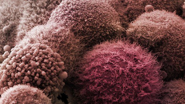 Καρκίνος στο πάγκρεας: Έγκαιρη διάγνωση με τεστ ούρων