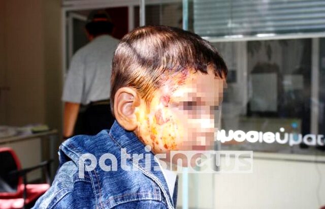 Πήγε να ζητήσει τα δεδουλευμένα και ο εργοδότης περιέλουσε με καυτό καφέ το εγγόνι της