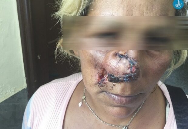 Ρόδος: Πέντε αθίγγανοι εναντίον 34χρονης. Της δάγκωσαν και της έκοψαν τη μύτη