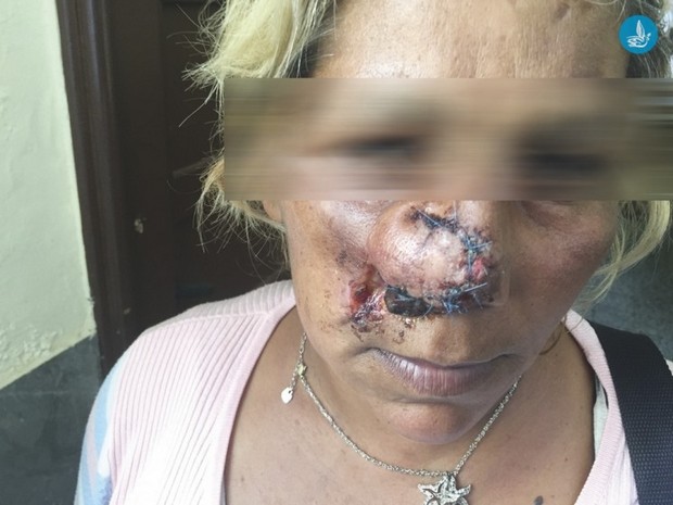 Ρόδος: Πέντε αθίγγανοι εναντίον 34χρονης. Της δάγκωσαν και της έκοψαν τη μύτη