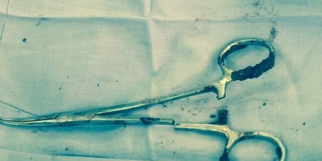 Απίστευτο: Ζούσε 18 χρόνια με ένα ψαλίδι μέσα στην κοιλιά του