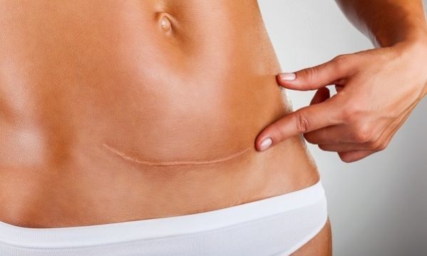 Υψηλό ποσοστό μη ενδεδειγμένων ιατρικά καισαρικών στη χώρα μας