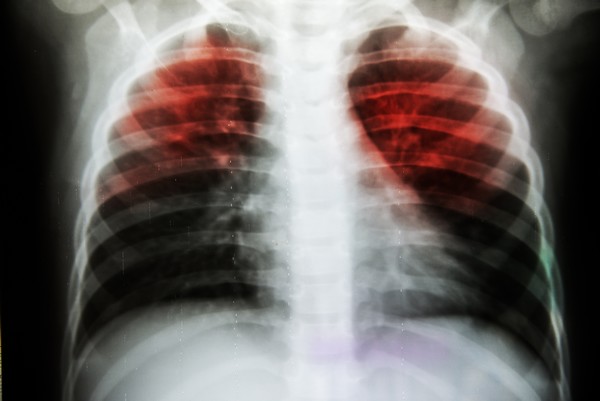 Αδιάγνωστοι και χωρίς πρόσβαση σε θεραπεία το 1/3 των ασθενών με φυματίωση