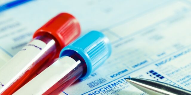 Ένα απλό τεστ αίματος ανιχνεύει έγκαιρα την τοξική πρωτεΐνη του Αλτσχάιμερ