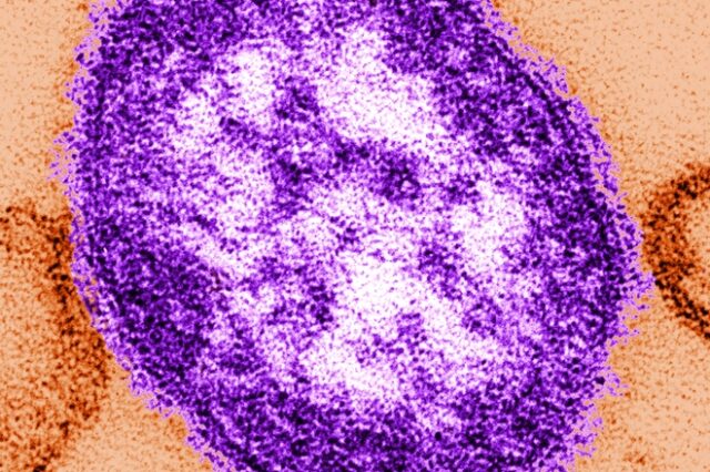 Υπ. Υγείας: Δεν τίθεται ζήτημα επάρκειας εμβολίων για την ιλαρά