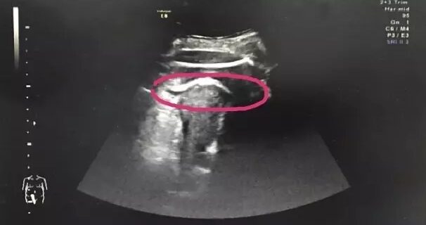 Απίστευτο περιστατικό: Έμβρυο κλώτσησε τόσο δυνατά που ‘έσπασε’ τη μήτρα της μητέρας