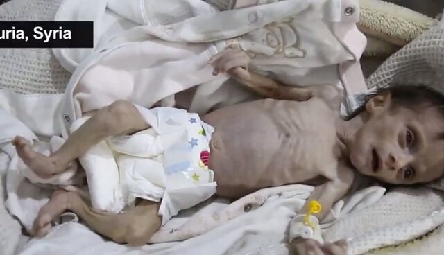 Σοκαριστικές εικόνες: Στη Συρία τα παιδιά πεθαίνουν από την πείνα
