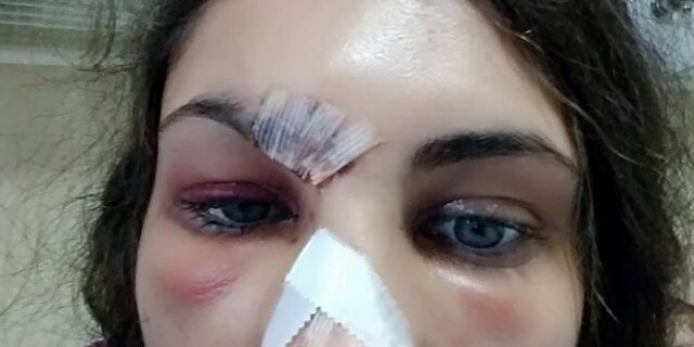 Στο νοσοκομείο με μώλωπες στο πρόσωπο μετήχθη γνωστό μοντέλο