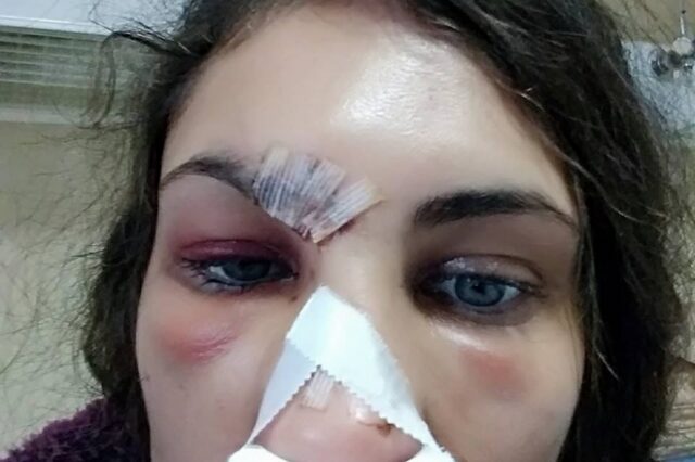 Στο νοσοκομείο με μώλωπες στο πρόσωπο μετήχθη γνωστό μοντέλο