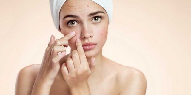 Η ακμή στο πρόσωπο αυξάνει το κίνδυνο κατάθλιψης