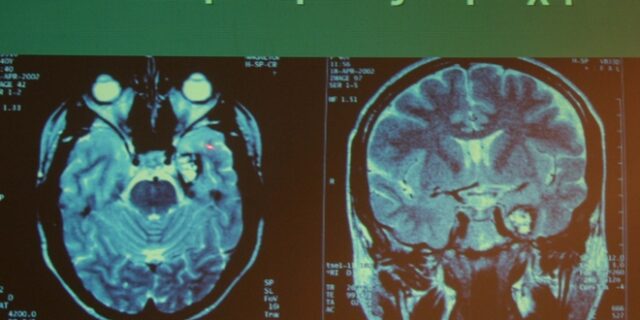 Έρευνα: Αυξημένος κίνδυνος θανάτου από μη φυσικά αίτια για ανθρώπους με επιληψία