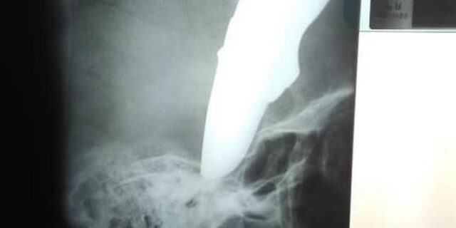 “Υπάρχει ελεύθερος γιατρός;”: Άνδρας με καρφωμένο μαχαίρι στο κρανίο πήγε ποδηλατώντας σε κλινική