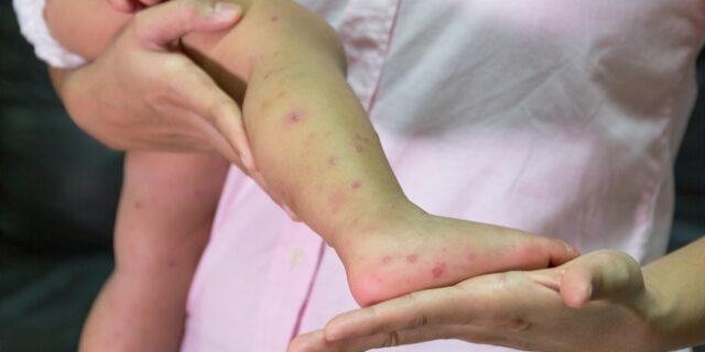 “Καμπανάκι” από την UNICEF: Αναζωπύρωση της ιλαράς σε παγκόσμιο επίπεδο