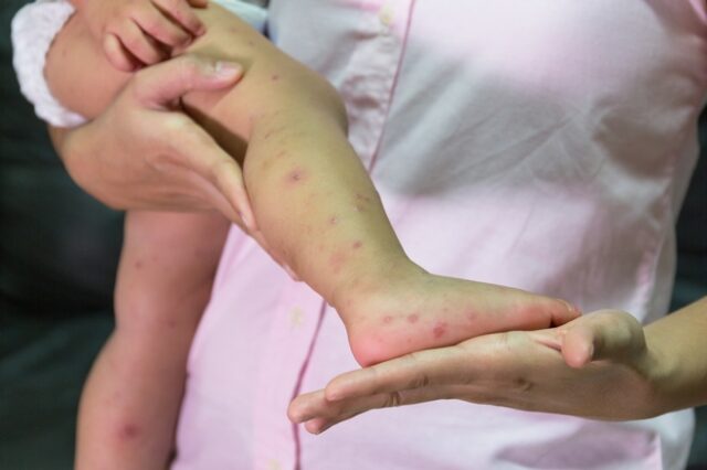 “Καμπανάκι” από την UNICEF: Αναζωπύρωση της ιλαράς σε παγκόσμιο επίπεδο