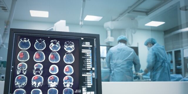 Έρευνα: Οι σοβαρές χειρουργικές επεμβάσεις μπορεί να έχουν επιπτώσεις στη λειτουργία του εγκεφάλου