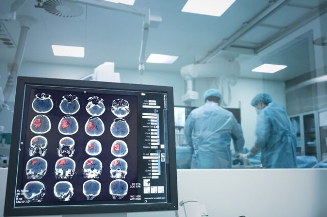 Έρευνα: Οι σοβαρές χειρουργικές επεμβάσεις μπορεί να έχουν επιπτώσεις στη λειτουργία του εγκεφάλου