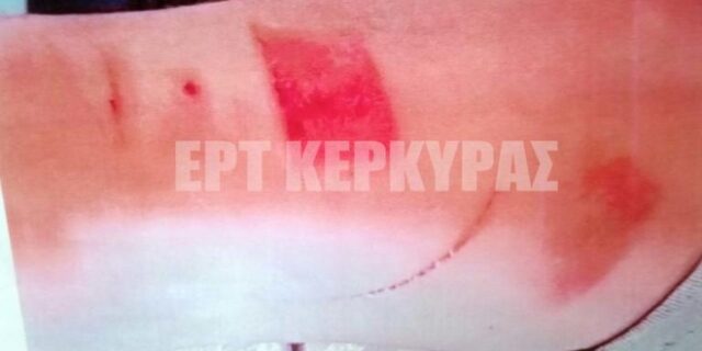 Κέρκυρα: Καταγγελία σπουδαστή μαγειρικής για “βασανιστήρια” που υπέστη σε κουζίνα εστιατορίου