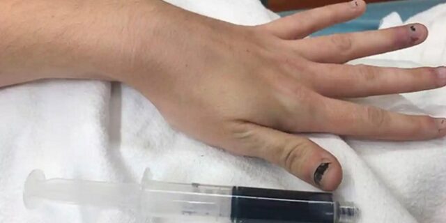 “Νιώθω αδύναμη και μπλε”: Ξύπνησε και το αίμα της είχε γίνει βαθυγάλανο