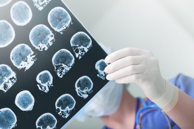 Ένα σοβαρό τραύμα στο κεφάλι αυξάνει τον κίνδυνο άνοιας ακόμη και μετά από δεκαετίες