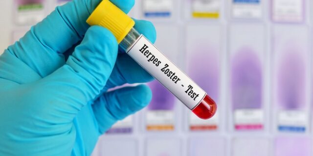 Υψηλός ο κίνδυνος εμφάνισης έρπητα ζωστήρα στους 60 και άνω που έχουν περάσει ανεμοβλογιά