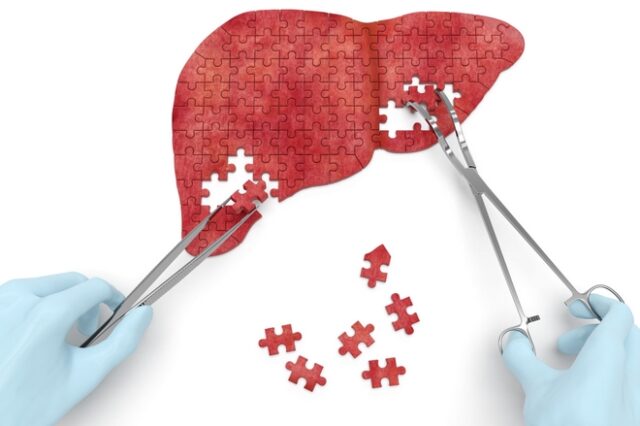 Liver Cancer Risk Assessment: Πεντάλεπτο τεστ αξιολόγησης κινδύνου για καρκίνο του ήπατος