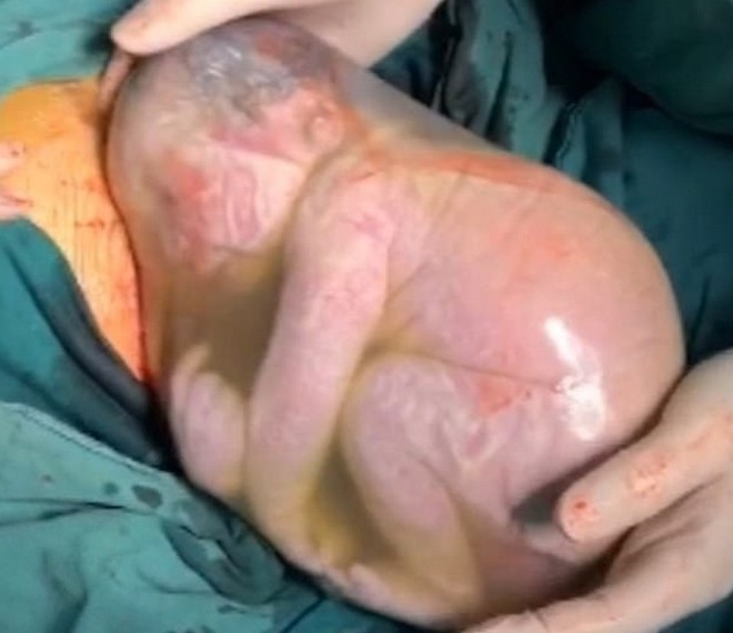 Συγκλονιστικές στιγμές: Μωρό γεννιέται ατάραχο μέσα στον αμνιακό του σάκο