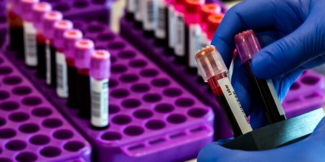 Κορονοϊός: Οι αιματολογικές επιπλοκές της λοίμωξης