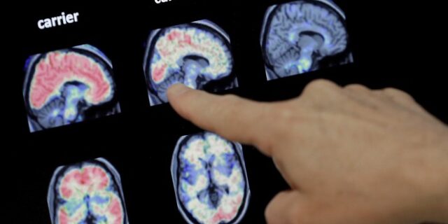 Αντίσωμα “ανιχνευτής” προειδοποιεί για Αλτσχάιμερ