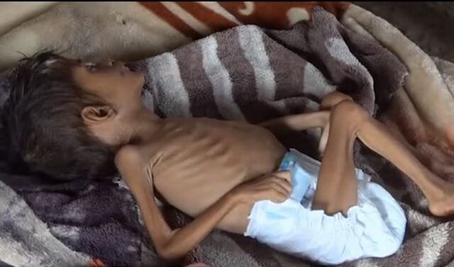 Τα παιδιά πληρώνουν το τίμημα του εμφυλίου στην Υεμένη