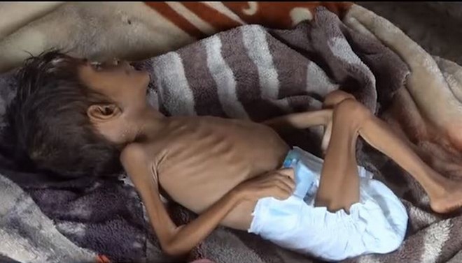 Τα παιδιά πληρώνουν το τίμημα του εμφυλίου στην Υεμένη