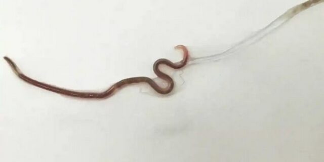 Είχε πονόλαιμο για μέρες – Της αφαίρεσαν ζωντανό σκουλήκι