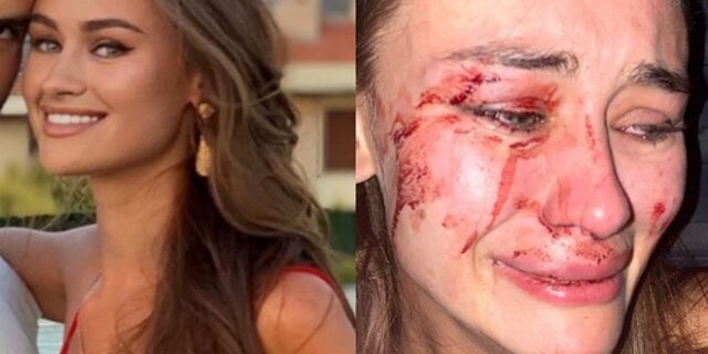 Ουκρανία: Διάσημο μοντέλο καταγγέλλει άγριο ξυλοδαρμό της στην Τουρκία