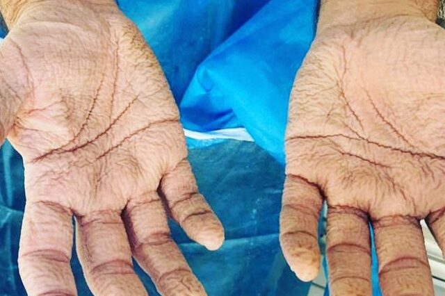 Σοκαριστική εικόνα: Τα χέρια νοσηλευτή μετά από 8 συνεχόμενες ώρες διενέργειας τεστ