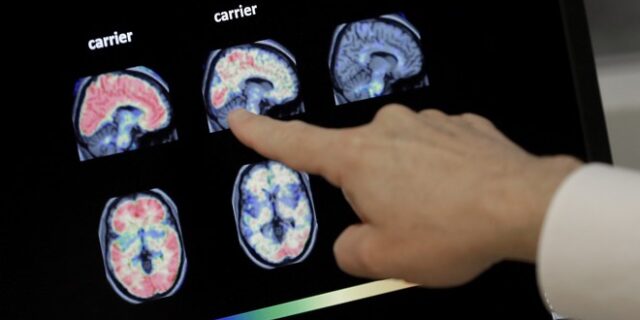 Αυξημένος ο κίνδυνος Αλτσχάιμερ για τους ηλικιωμένους που πέρασαν κορονοϊό