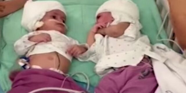 Σιαμαία κοριτσάκια κοιτάχτηκαν για πρώτη φορά μετά από επέμβαση