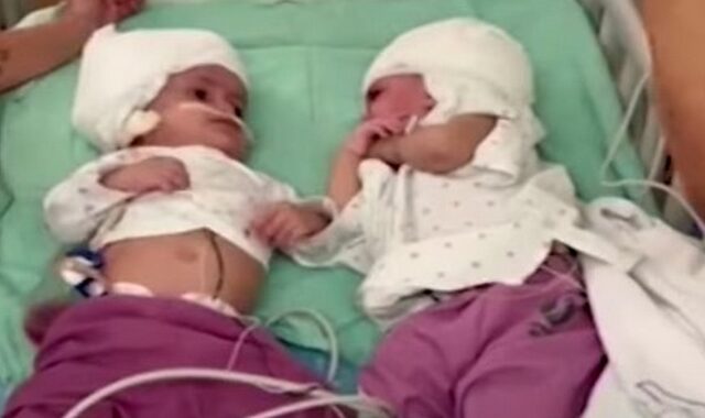 Σιαμαία κοριτσάκια κοιτάχτηκαν για πρώτη φορά μετά από επέμβαση