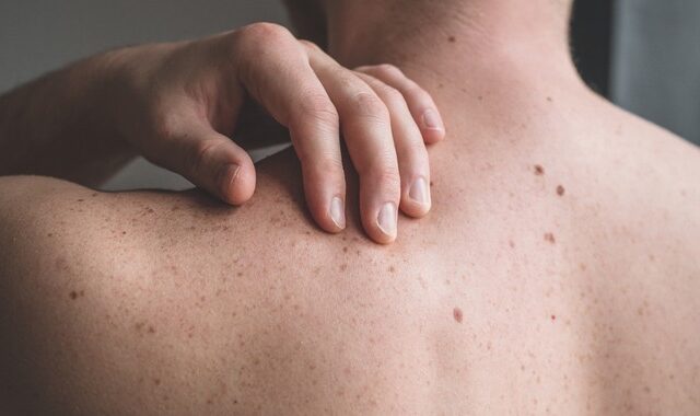 Μελάνωμα: Τεστ προβλέπει με ακρίβεια αν ο καρκίνος του δέρματος είναι πιθανό να εξαπλωθεί