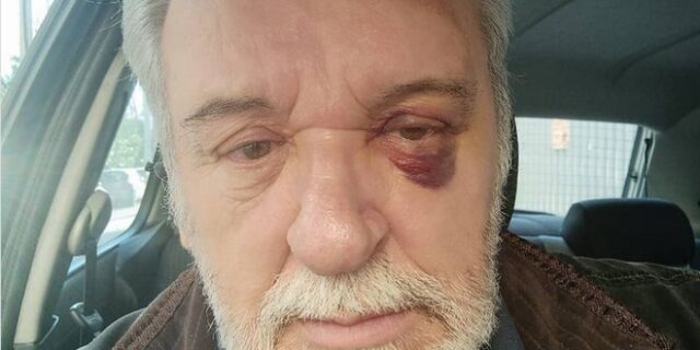 Ο Τάσος Χαλκιάς με μαυρισμένο μάτι – “Άλλο ένα τραύμα, σωματικό αυτή τη φορά”