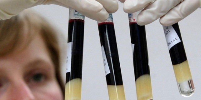 HIV: Τρίτος ασθενής απαλλάχτηκε από τον ιό με μεταμόσχευση βλαστοκυττάρων