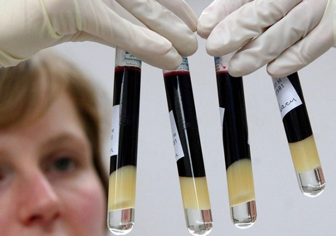 HIV: Τρίτος ασθενής απαλλάχτηκε από τον ιό με μεταμόσχευση βλαστοκυττάρων
