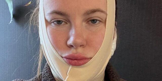 Η Άιρλαντ Μπάλντουιν έκανε λίφτινγκ στα 26 της – Θύελλα αντιδράσεων στα social media