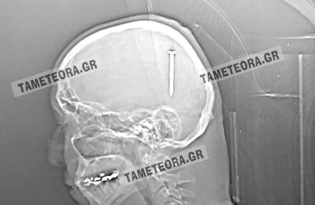 Καλαμπάκα: Καρφί 5 εκατοστών σφηνώθηκε στο κεφάλι άνδρα