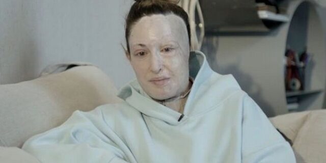 Ιωάννα Παλιοσπύρου: “Το έγκαυμα ίσως είναι το μεγαλύτερο παγκοσμίως”, λέει η γιατρός της