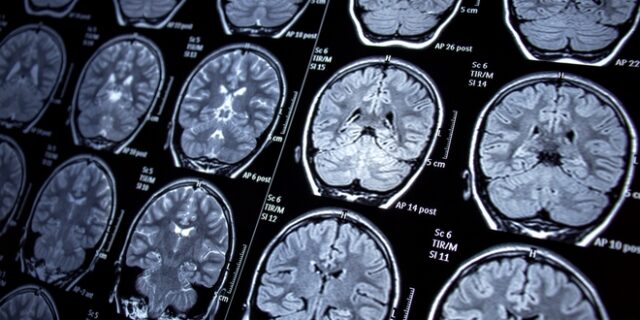 ΗΠΑ: “Φουντώνει” το μυστήριο για τα σχεδόν 100 περιστατικά σπάνιων καρκίνων σε σχολείο