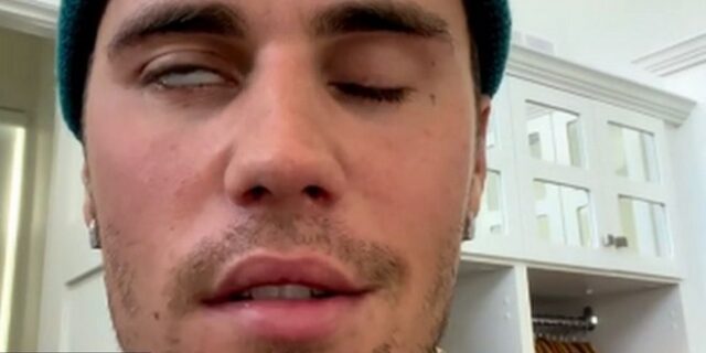 Ο Justin Bieber αποκάλυψε ότι πάσχει από το σύνδρομο Ράμσεϊ-Χούντ – Παρέλυσε το πρόσωπό του