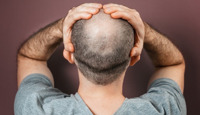 Φαλάκρα: Ερευνητές βρήκαν τον τρόπο να φυτρώνουν μαλλιά σε μόλις 10 ημέρες