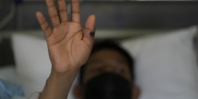 Ευλογιά των πιθήκων: Ξεπέρασαν τα 50.000 τα κρούσματα παγκοσμίως